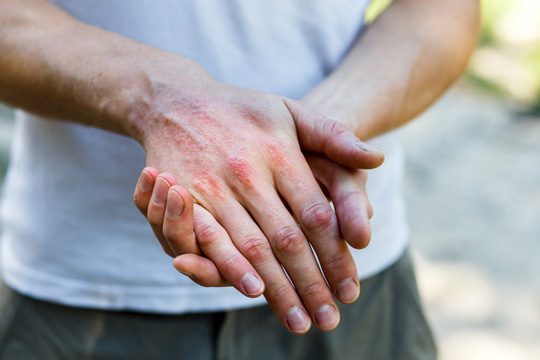 Hand eczema with red, dry and irritated skin on the back of the hands.