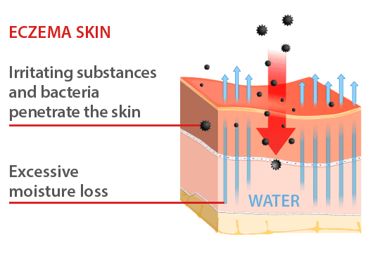 Diagram comparing healthy skin and eczema skin, showing how a damaged skin barrier allows irritants to enter and increases moisture loss: eczema skin.