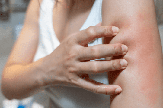 Women have itchy skin and red rashes